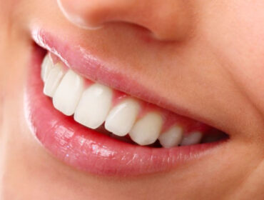 smile ready copertura dentale